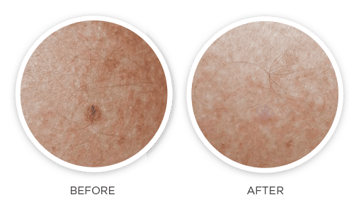 Before and after CryoLab treatment on dark skin