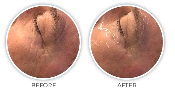 Before and after CryoTouch facial treatment